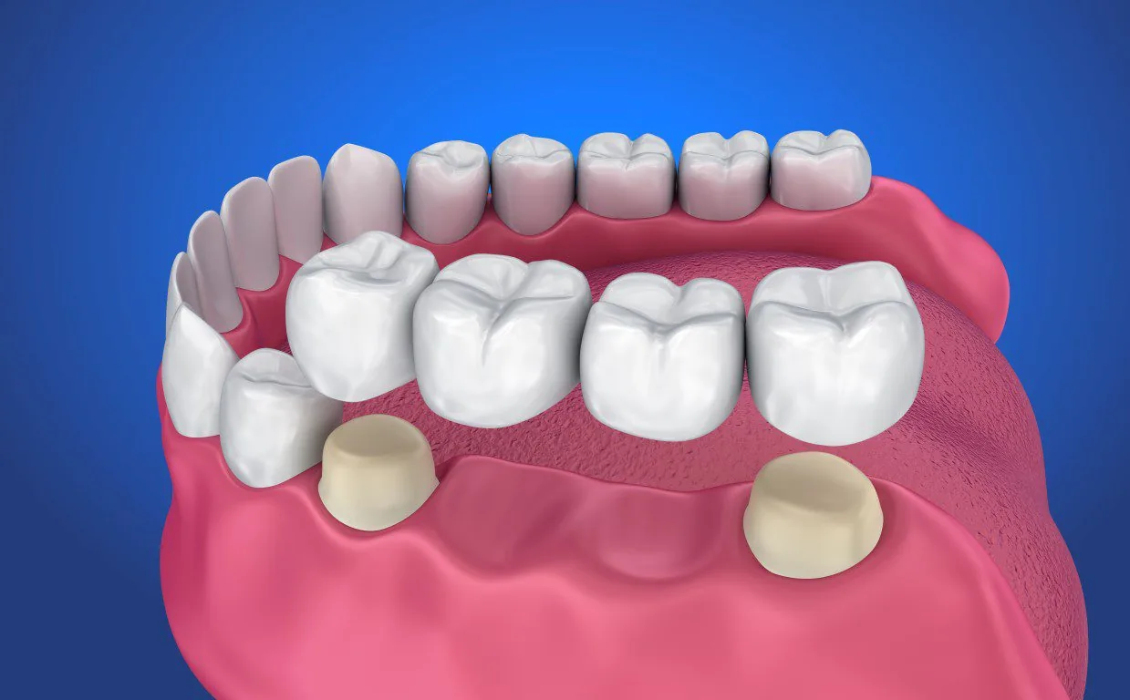 image showing a tooth bridge, what it is and how it works.