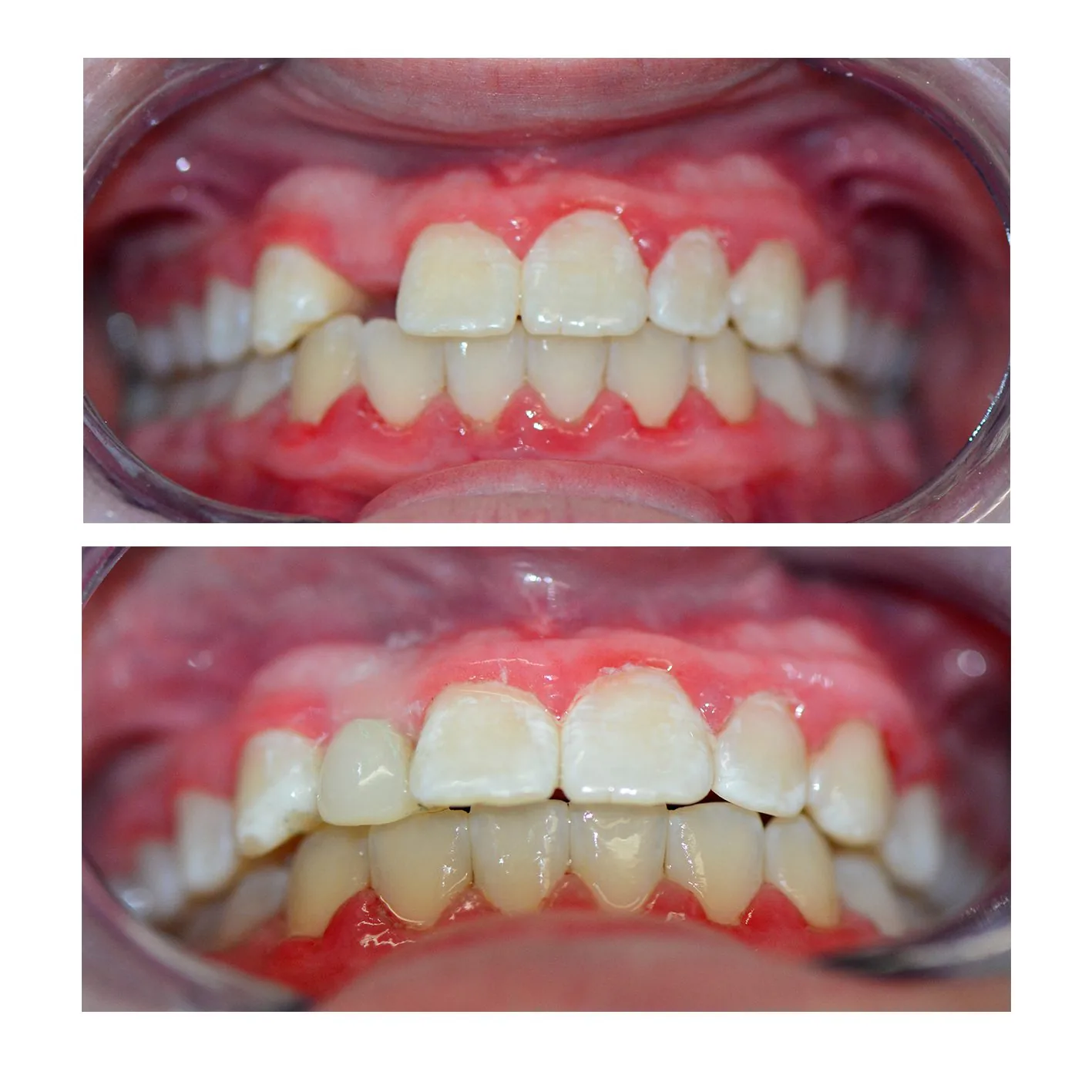 Before and after photographs of front teeth restored with tooth-coloured composite fillings at Hobart Place Dental