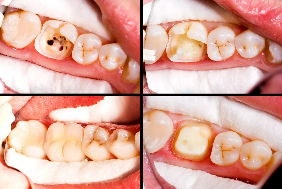 image showing the process of placing and restoring a crown onto a tooth