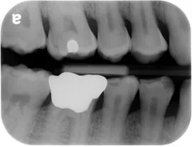 image showing a tooth highlighted in an xray