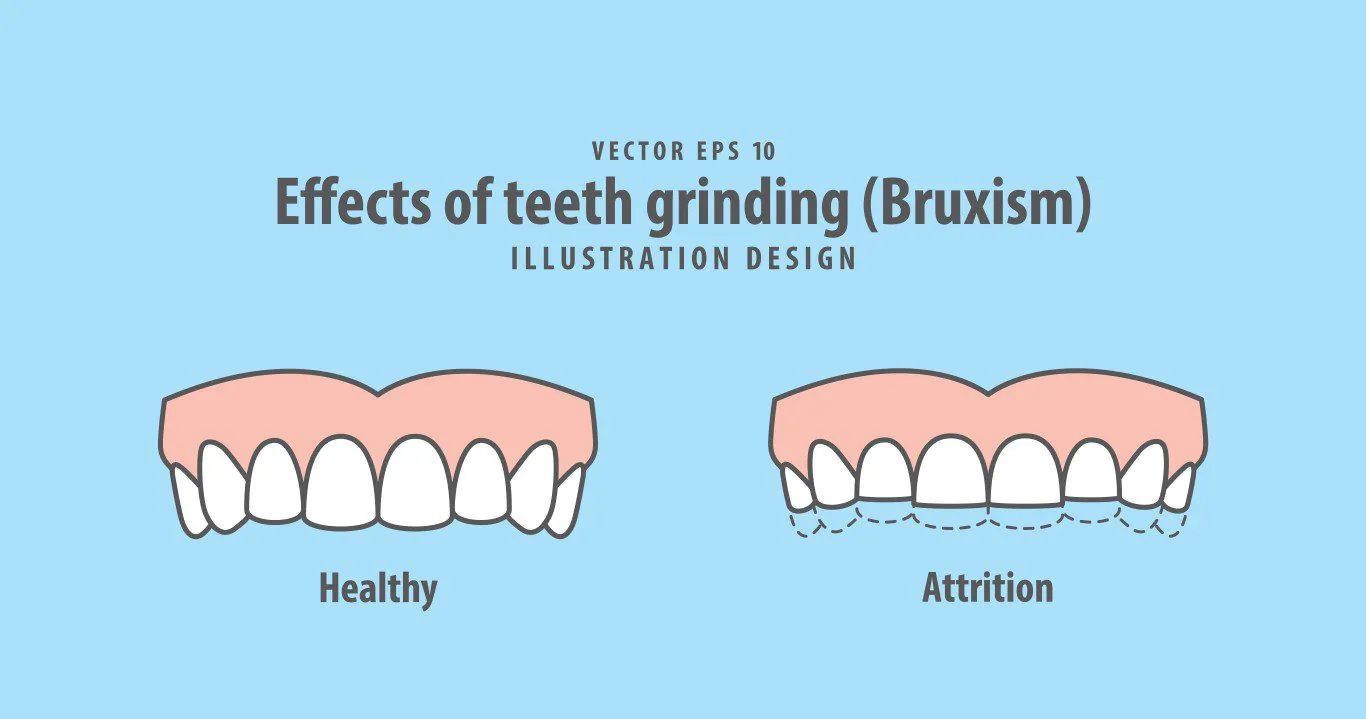 illustration showing the effects of teeth grinding