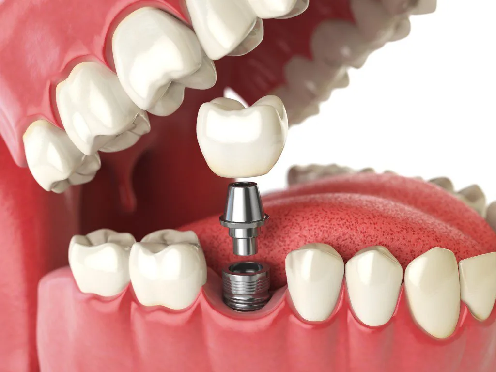 image showing the parts of a tooth implant and how it works