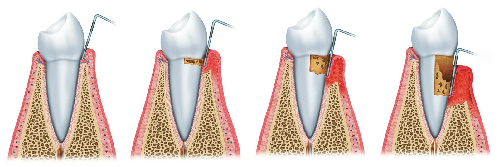 image showing the steps of periodontal health and gum disease