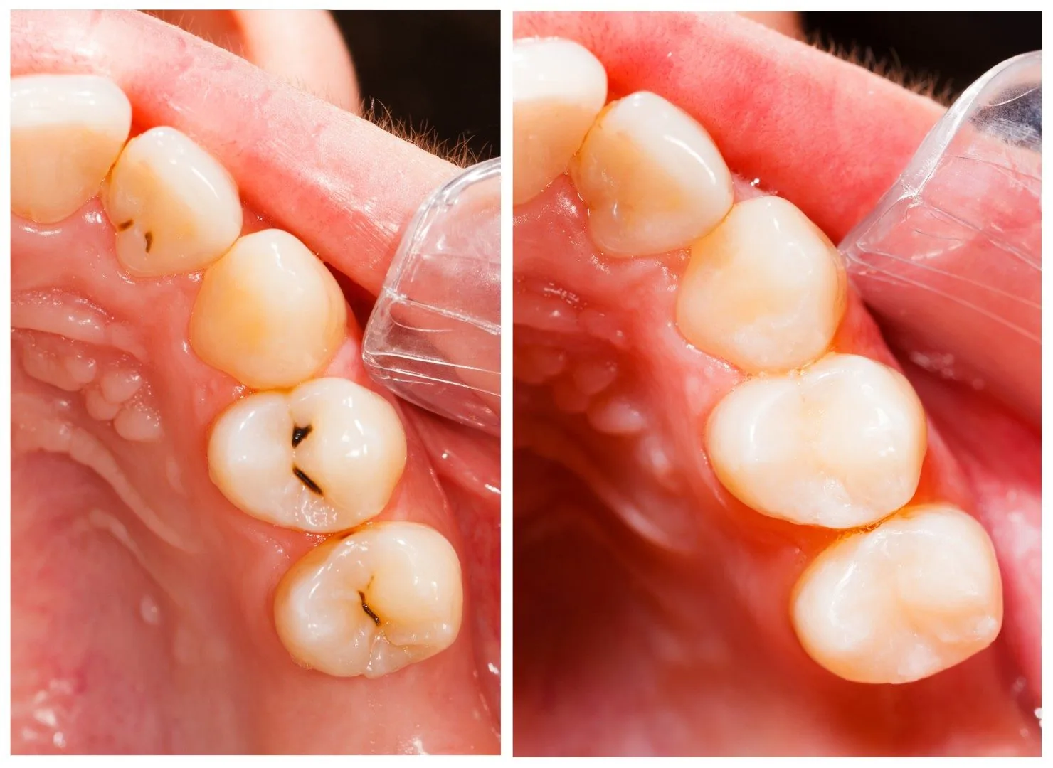 image showing tooth coloured fillings and a before and after of dental work
