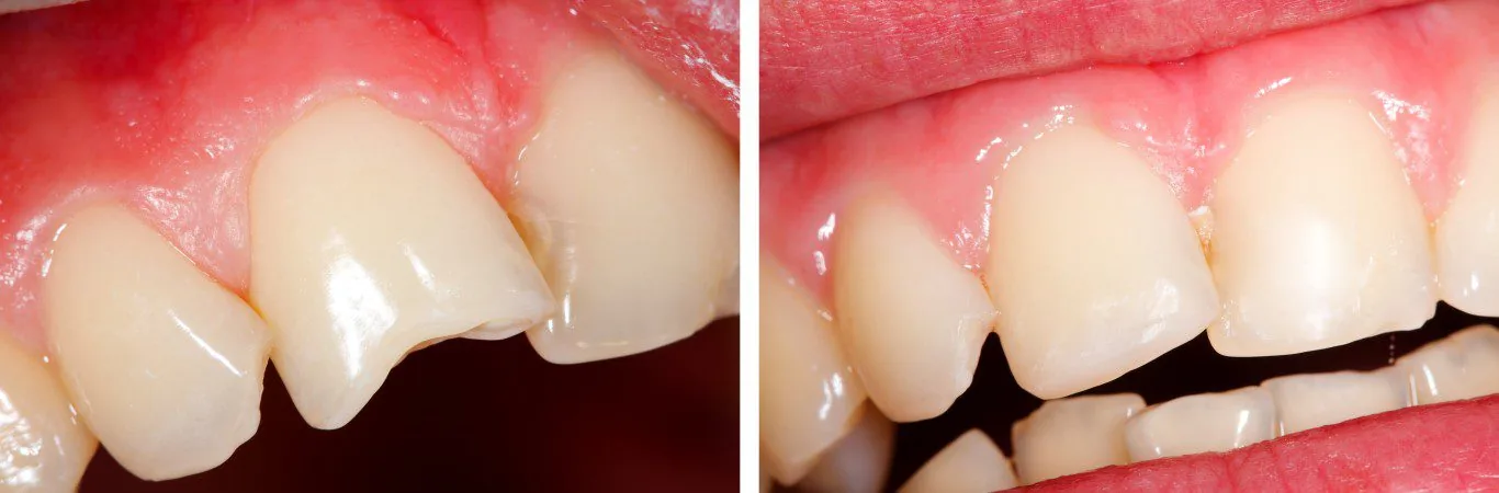 teeth restoration before and after showing a filling