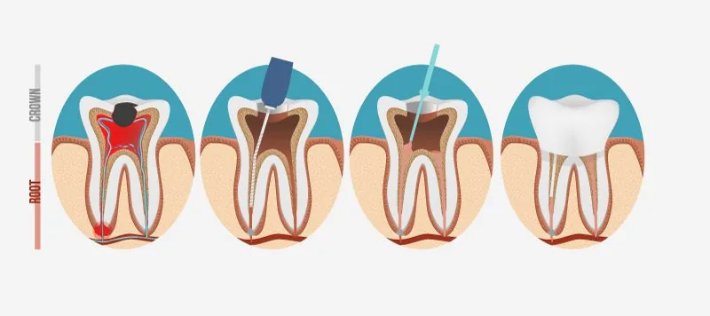 graphic showing the process of root canal therapy in four steps