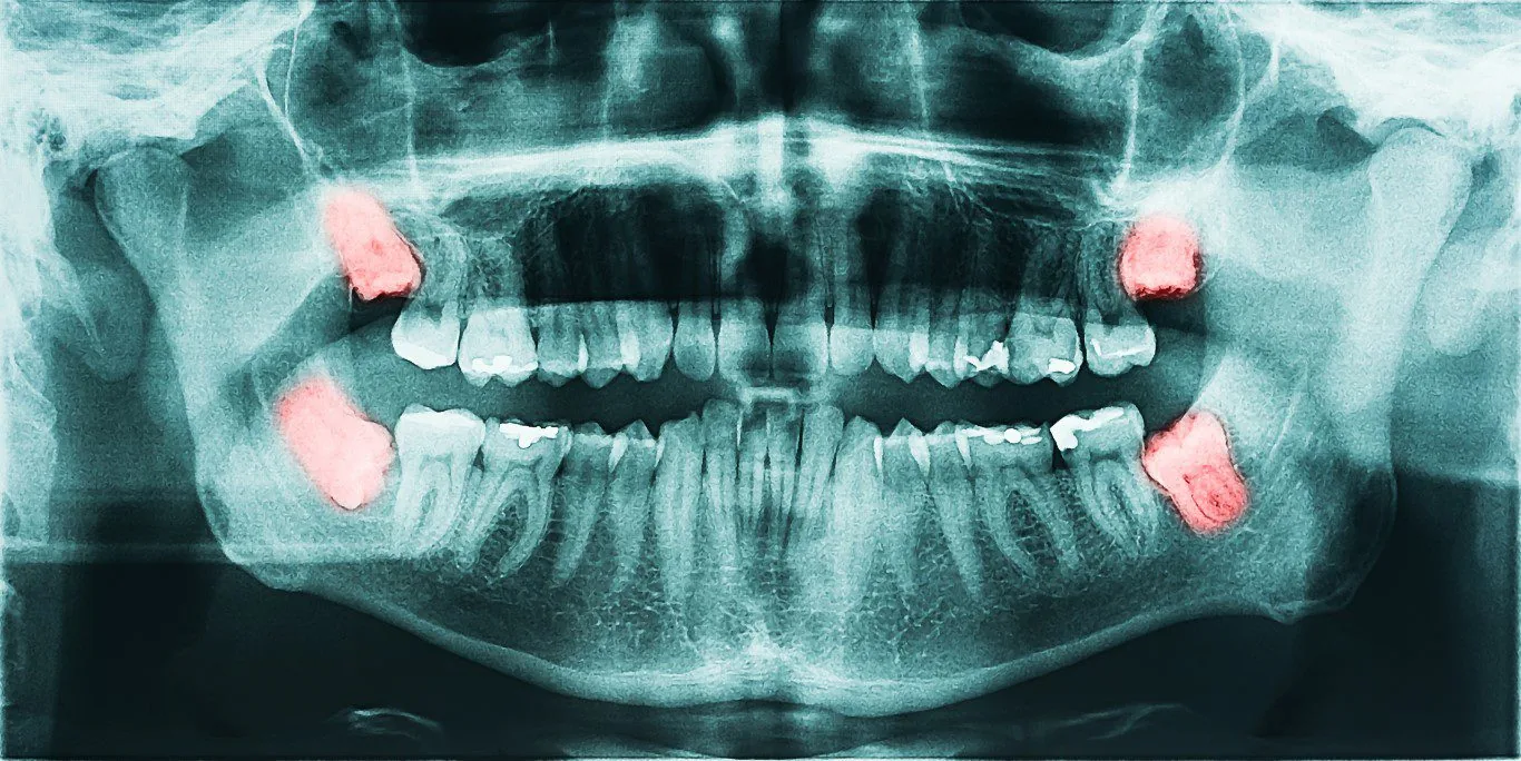 wisdom teeth xray